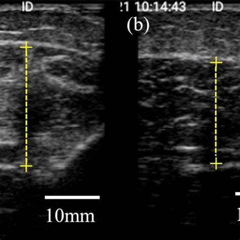 thickness measurement and shear evaluations|The value of ultrasound measurement of muscle thickness at .